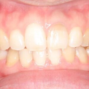 プレオルソ　ユーティリティ 今日は　矯正専門医向けです